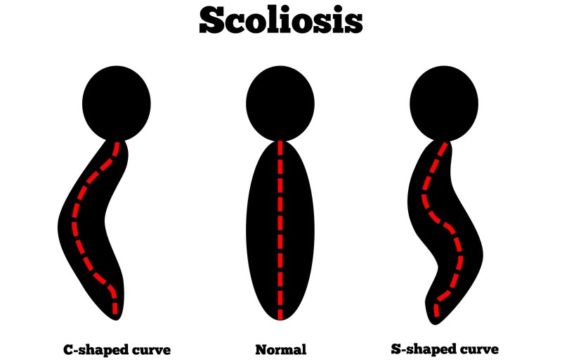 Rolla, MO scoliosis treatment